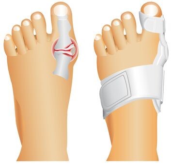How can you shorten the time it takes to recover from bunion surgery?