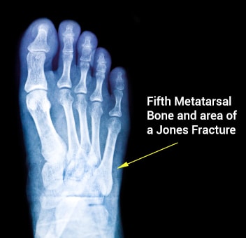 Image result for jones fracture